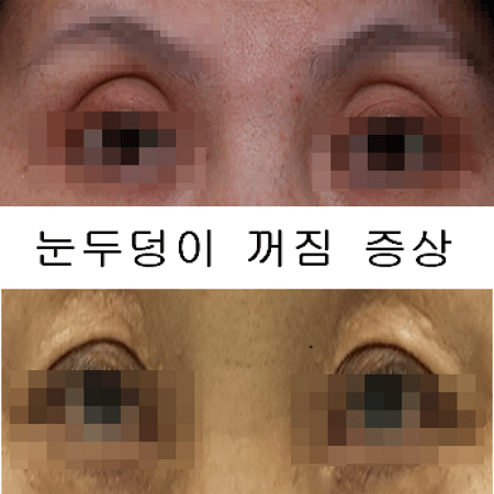 눈두덩이 꺼짐이 심한 여성과 남성의 모습
