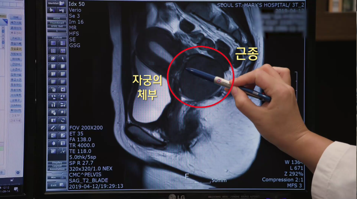 자궁근종