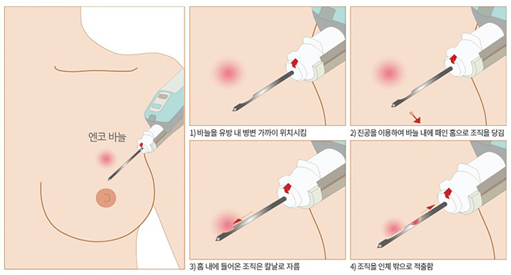 맘모톰 수술 비용 실비 맘모톰 후기(유방 섬유선종)