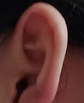  귓볼몽우리 무슨 질병일까? 원인 치료방법 정리