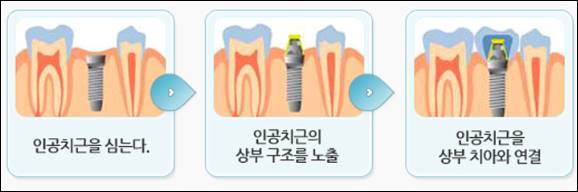 홍천 임플란트 가격 비용 잘하는 치과 저렴한 싼 곳 추천 의원 병원 오스템 수면 틀니 전체 상악 뼈이식 원데이 네비게이션 앞니 어금니