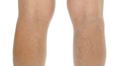  하지 정맥 원인 초기증상과 약물치료