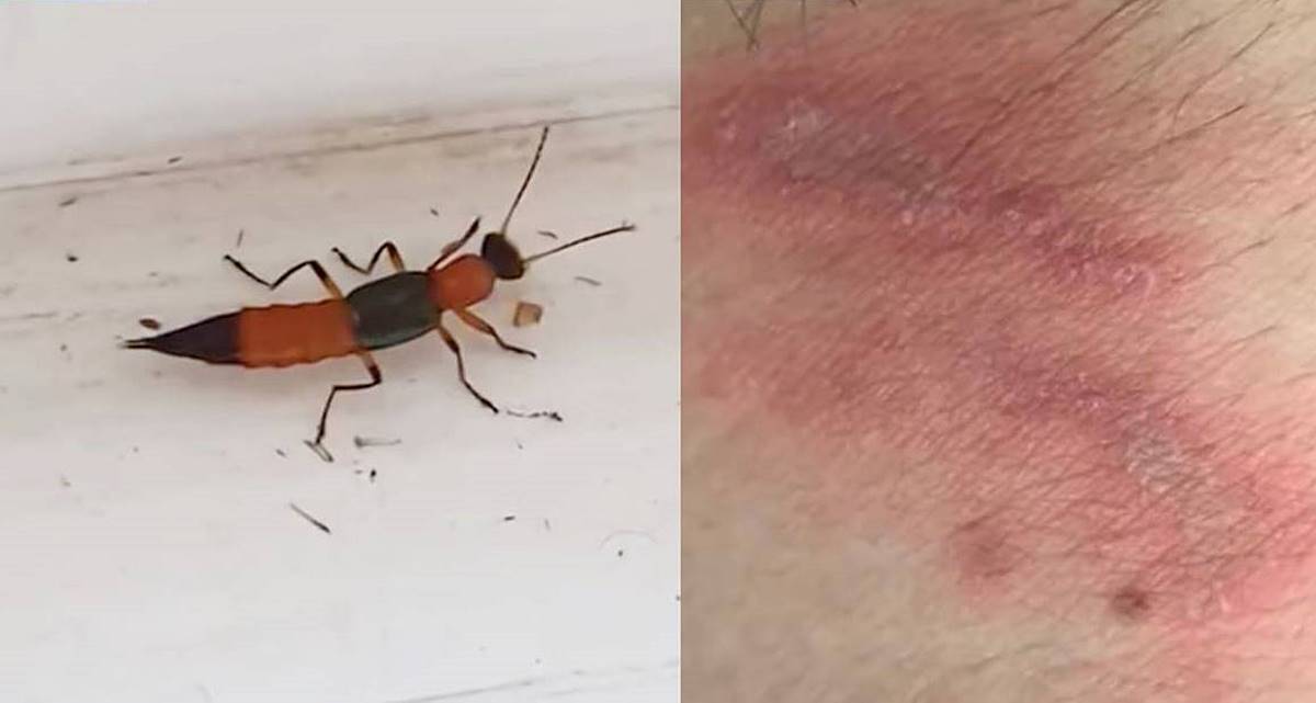  화상벌레 물렸을 때 절대 하지말아야 할 행동과 대처 방법