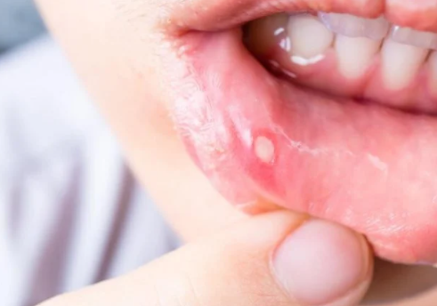  구내염 빨리 낫는법 (헥사메딘, 알보칠, 오라메디 사용법, 부작용, 효과)