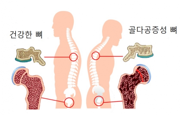  골다공증과 MBP의 상관관계(강한 뼈에 대한 열쇠)