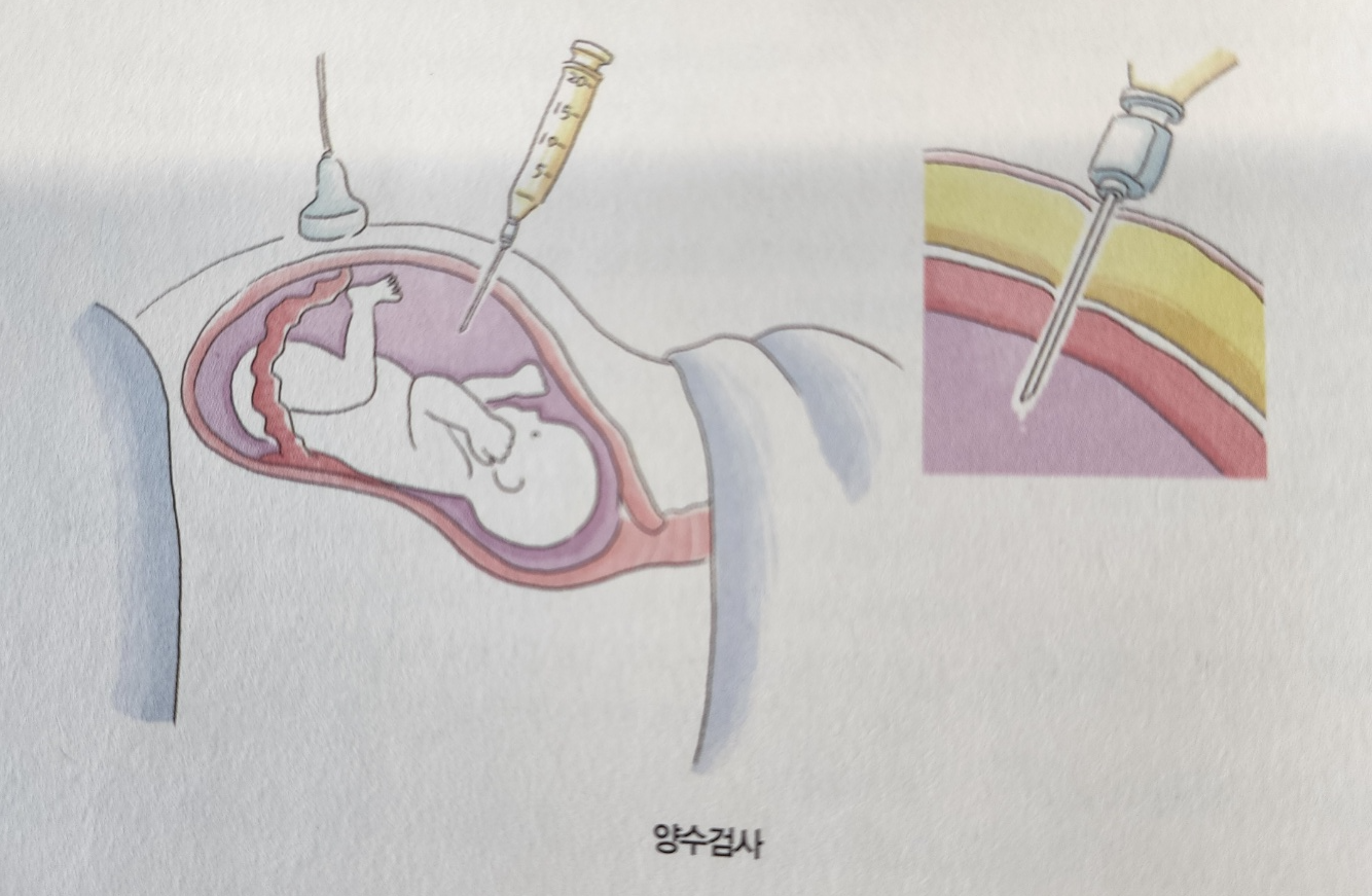  양수 검사 대해 알아보자 (검사 방법, 합병증, 검사 대상자 등등)