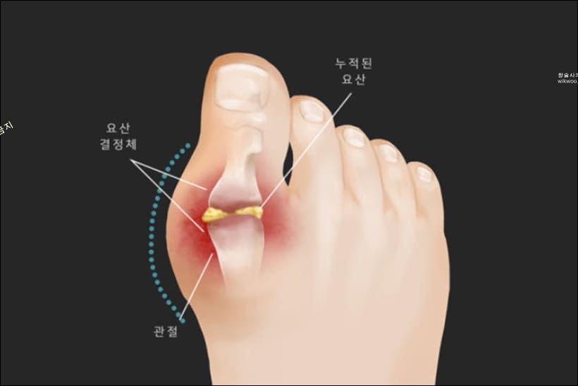 통풍 요산 수치