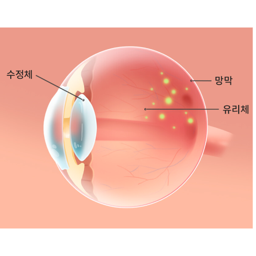 실명을 부르는 망막박리 들어보셨나요? 예방법 알아봅시다.