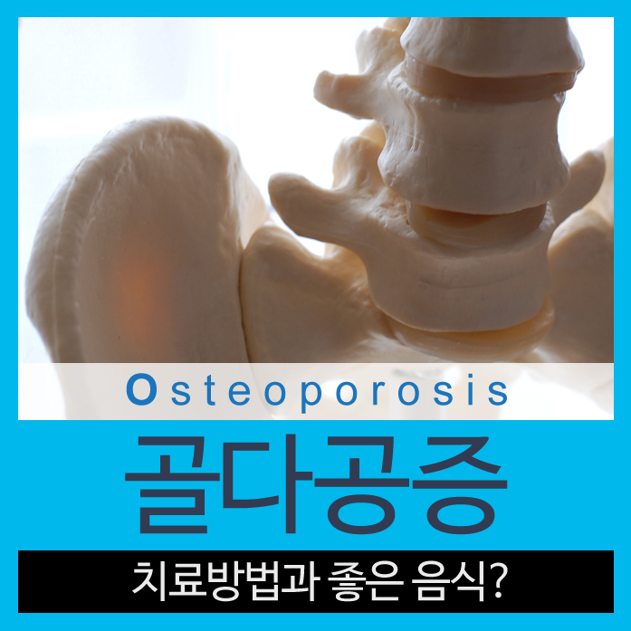 뼈에 좋은 음식과 골다공증 치료방법