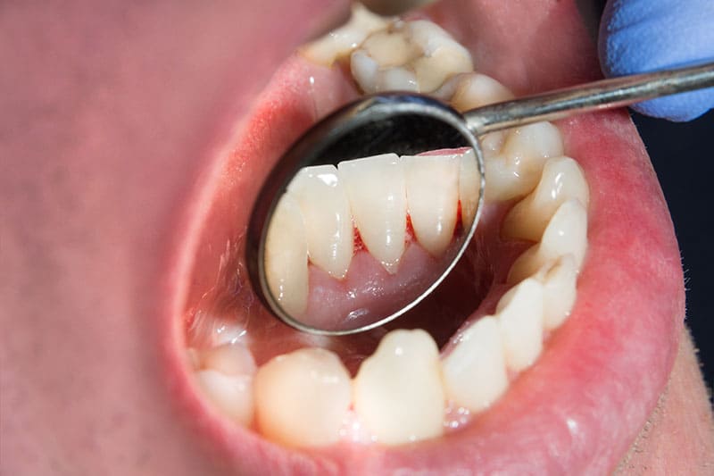  요즈음 양치 더 잘해야  ㅣ 잇몸 질환 있는 COVID-19 환자 위험하다  Not brushing your teeth may increase your risk of severe COVID-19