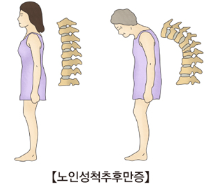 척추 후만증