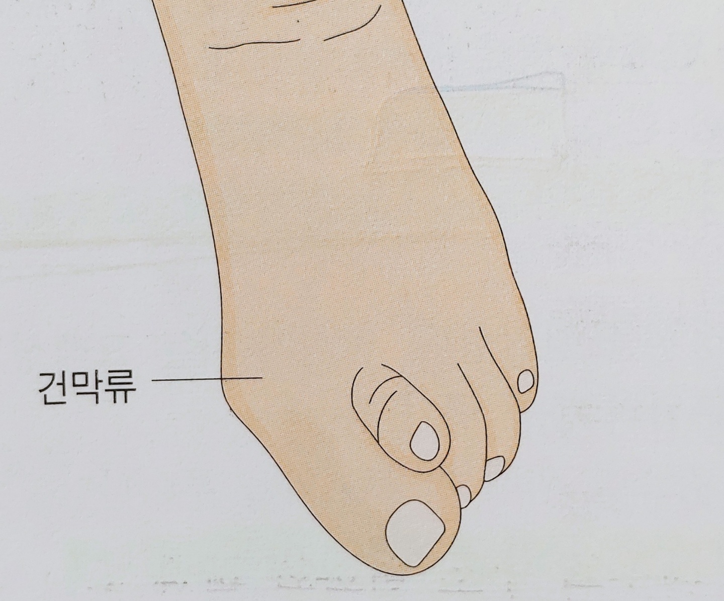  무지외반증 원인, 증상, 예방 및 치료방법 총정리