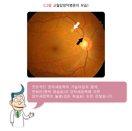  고혈압망막병증