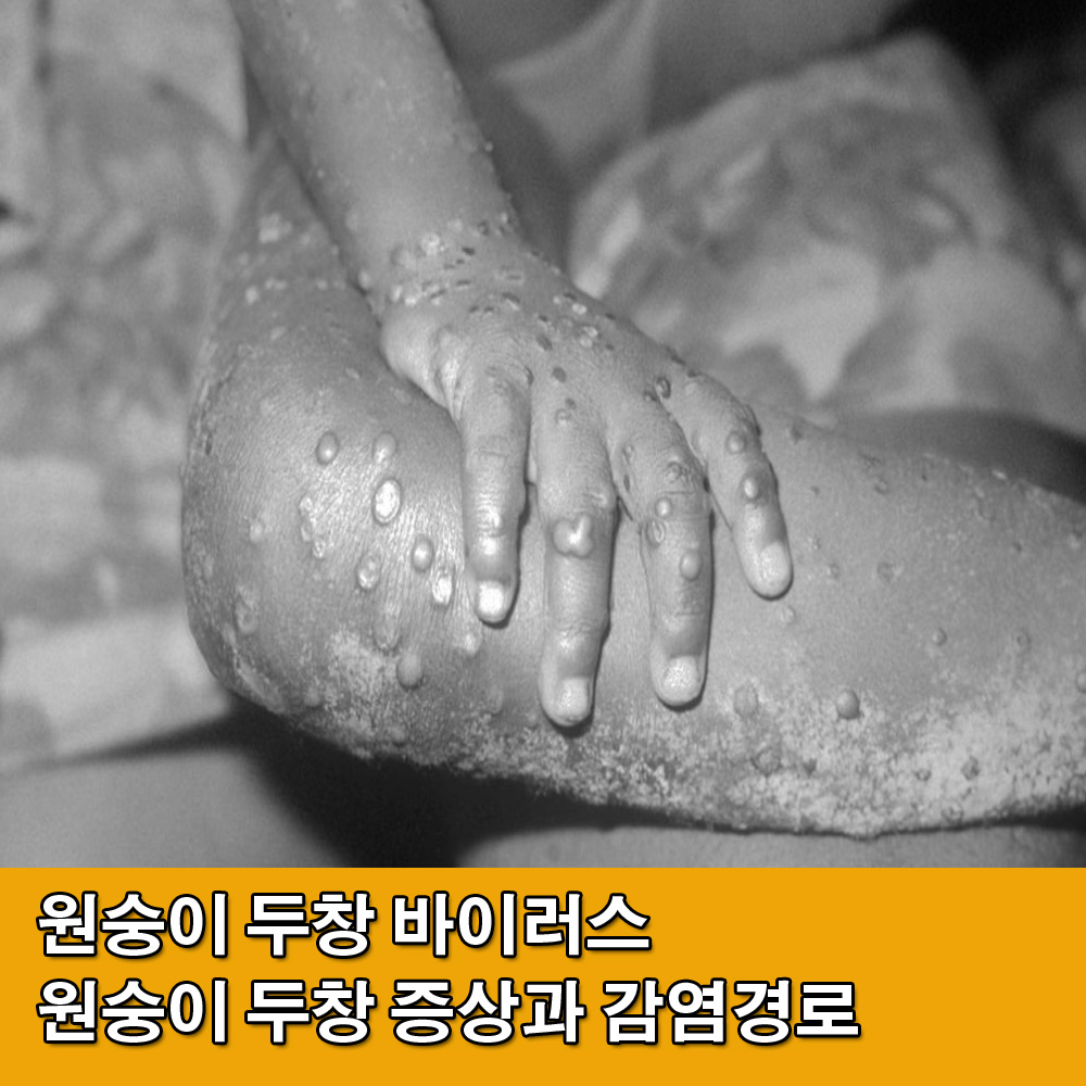  원숭이 두창.원숭이 두장 국내 확진자 발생.원숭이 두창 증상