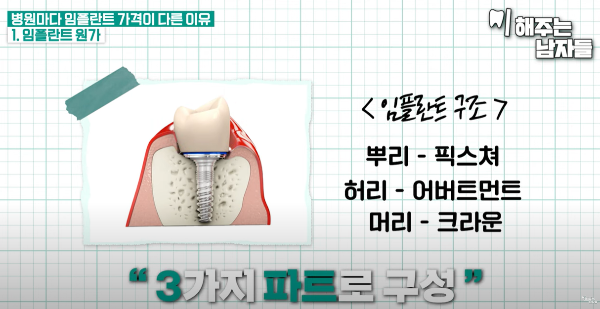 임플란트 구조