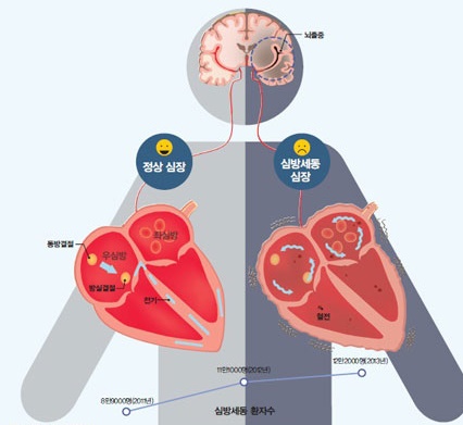 정상심장과 심방세동 심장의 차이