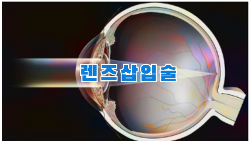 렌즈삽입술