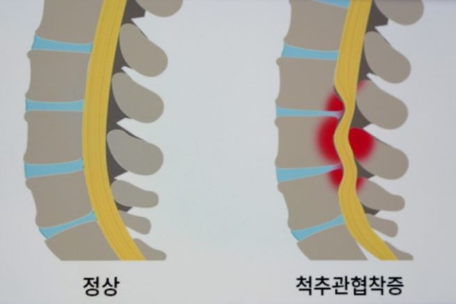 허리 협착증 증상