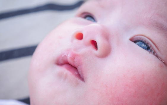 아토피성 피부염 유아기
