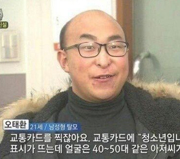  탈모 걱정 21살 청년