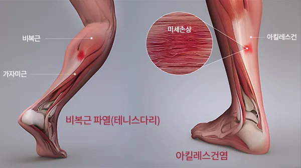 종아리 근육 통증 원인