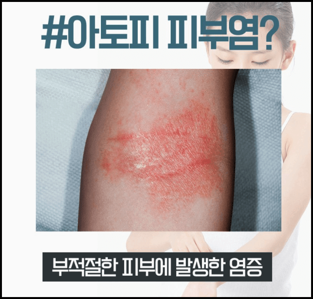  아토피 원인 치료 증상 등 총정리