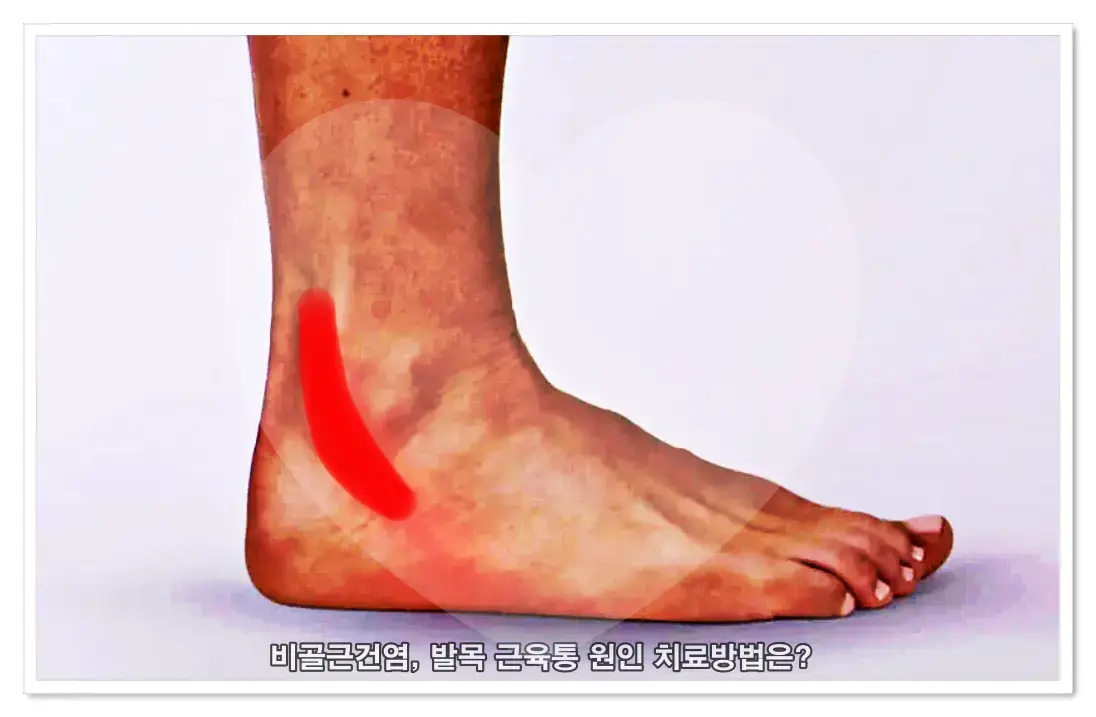 비골근건염