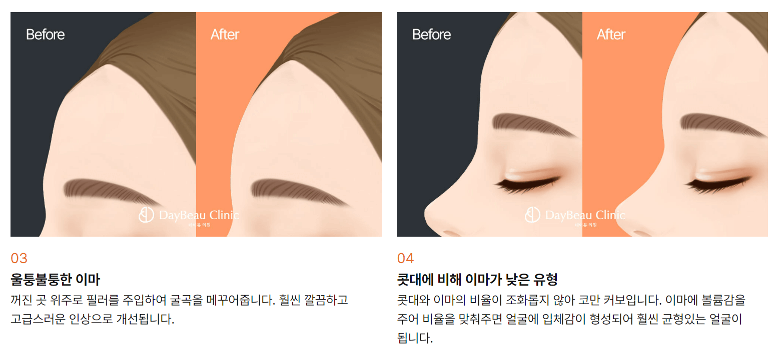 이마 필러 가격 효과 부작용 후기