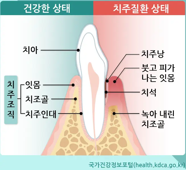 스케일링-치주질환-예방