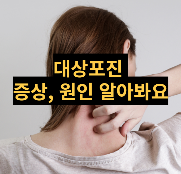  [건강정보] 대상포진 증상, 원인, 예방하는 방법