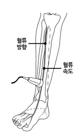 도플러 초음파