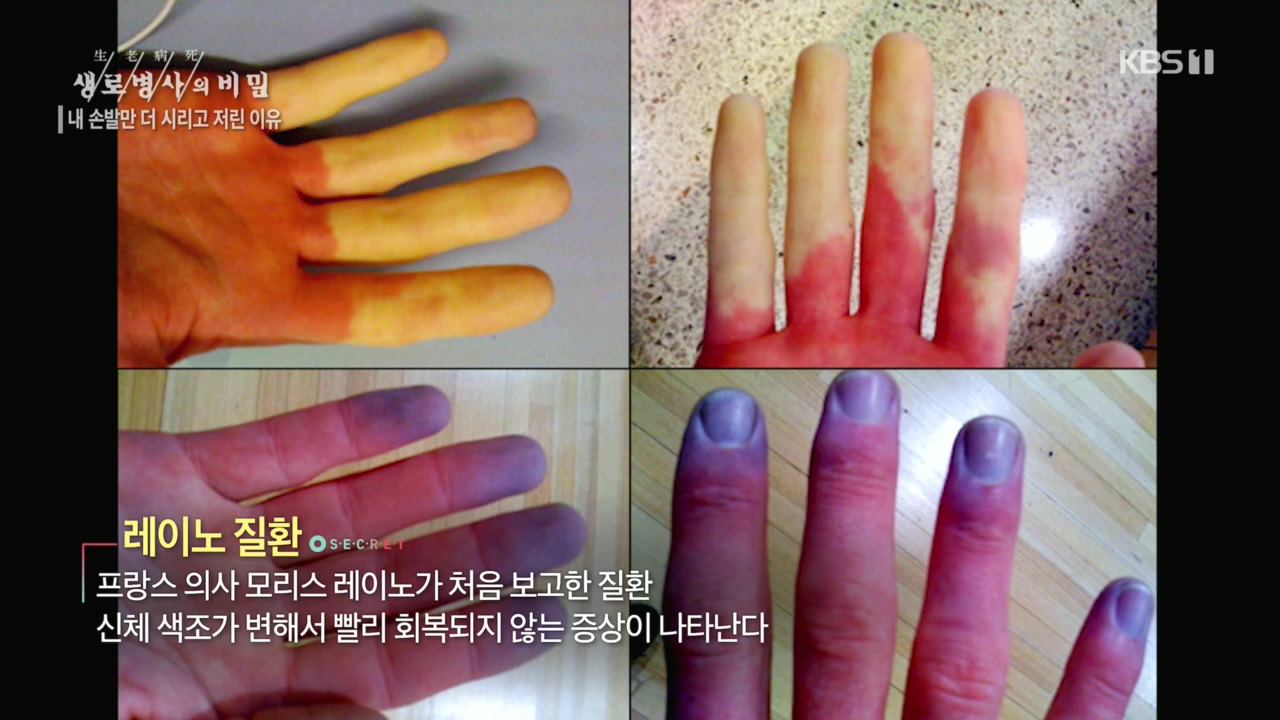 생로병사의 비밀.E847.221215p.H264-F1RST.mp4_20221215_194600.718.jpg