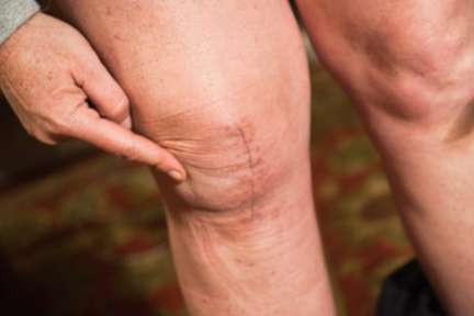 과도한 운동이 무릎연골연화증에 미치는 영향2