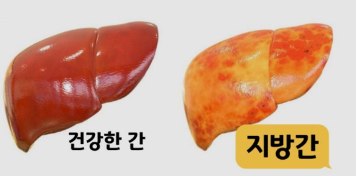 건강한 간과 지방간