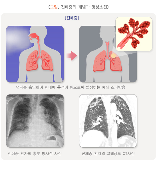  진폐증