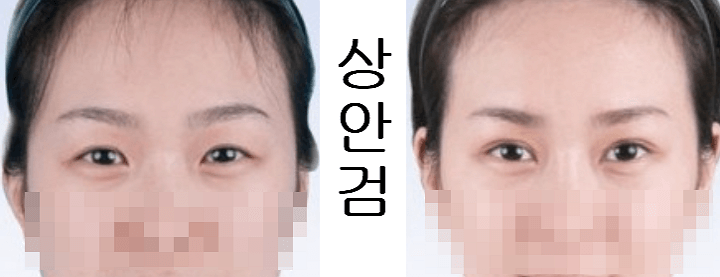 상안검 수술 전과 후 비교사진
