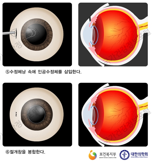 백내장 수술방법