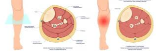 종아리-근육-통증-구획증후군
