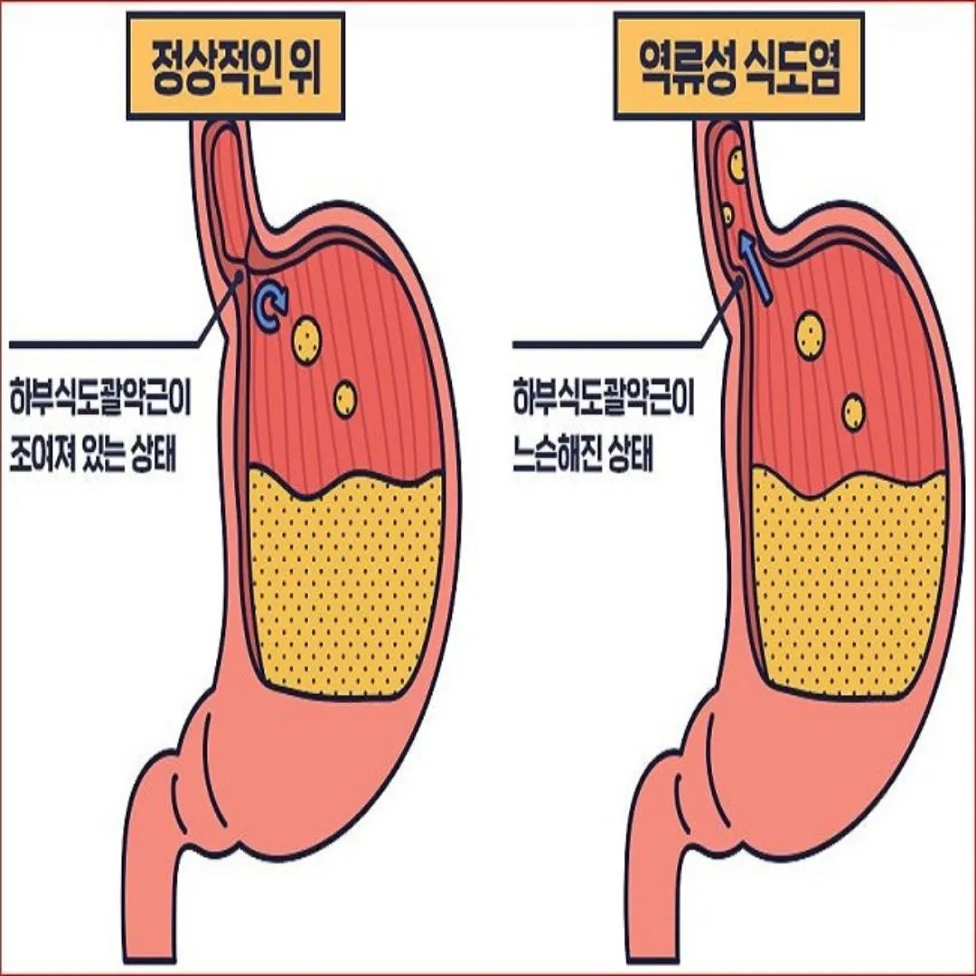 역류성 식도염 증상과 자연치료 방법