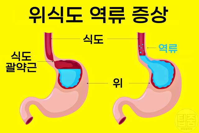 음식 빨리 먹으면 음식 빨리 먹는 사람 밥 빨리 먹으면 안되는 이유 속쓰림 위식도역류