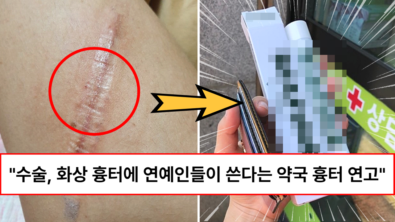 “기적처럼 없어집니다” 아무일도 없었다는 듯 흉없이 새살 돋게 한다는 약국 상처별 흉터 연고 (+6가지)