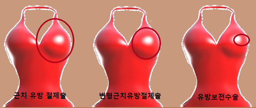  유방암 수술 방법이란? 유방암 수술 후 운동법이란? 유방암.