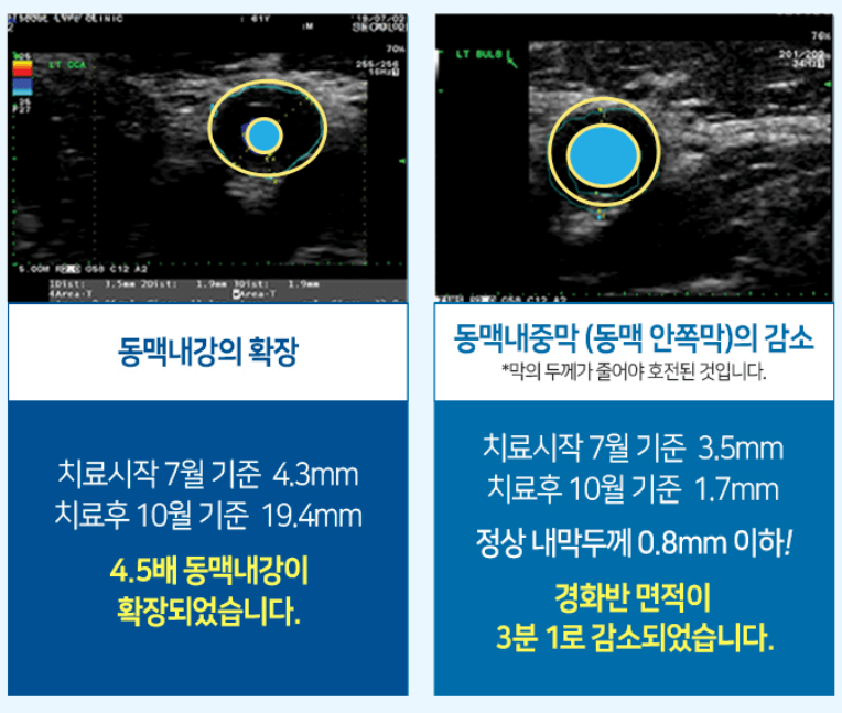 동맥경화 검사비용 동맥경화 치료방법