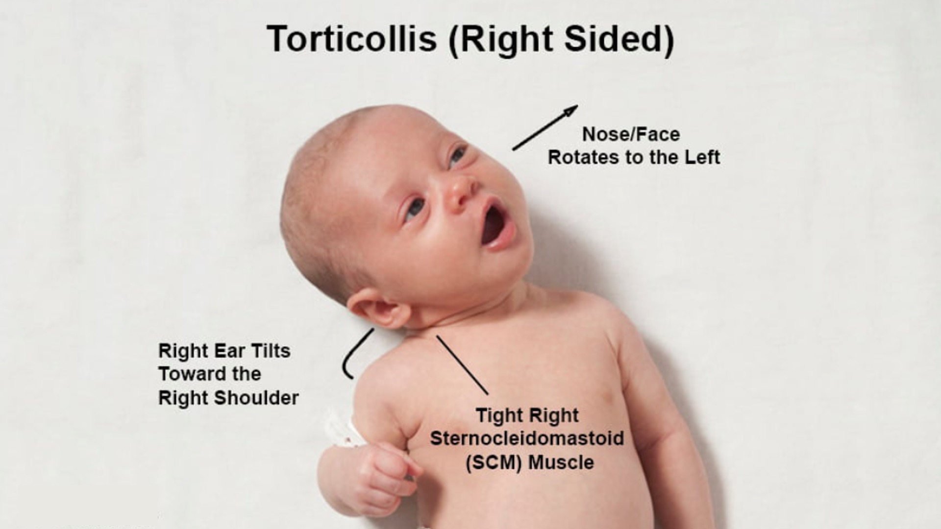 congenital-torticollis