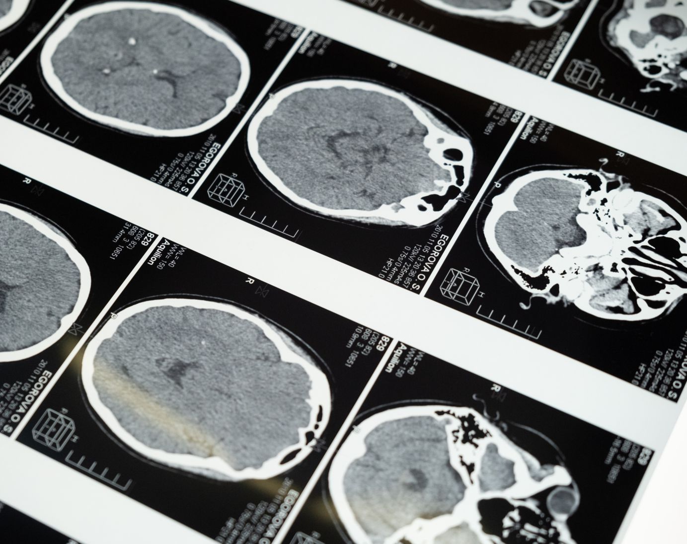 뇌 MRI 사진