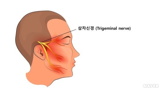 삼차 신경통