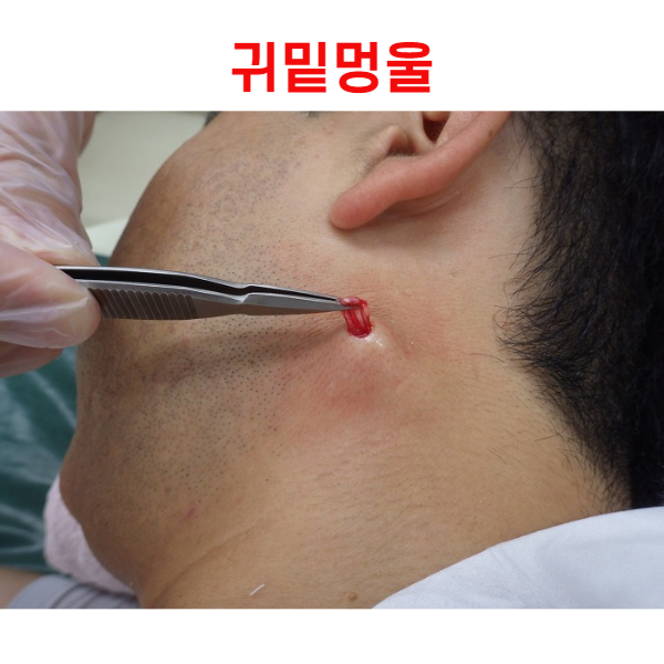  귀밑멍울 침샘종양: 이유와 해결 방법