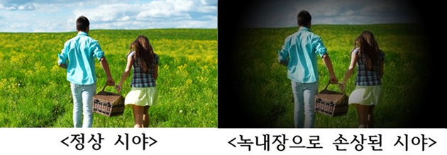  부산 LEE 안과 제공 – 녹내장, 실명 원인 3위