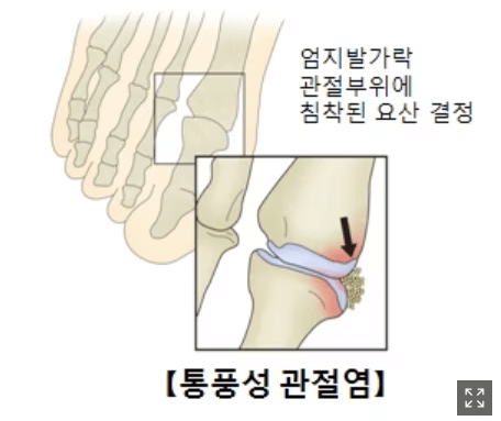 통풍 관련주 대장주 환자 50만명