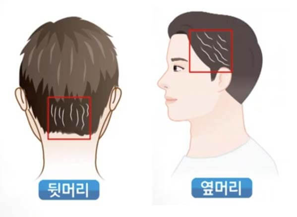  20대 흰머리 원인 7가지 - 흰머리 부위에 따른 건강 적신호 3가지